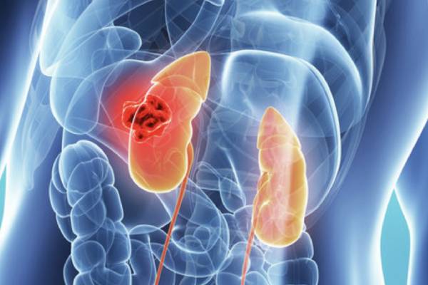 Kidney Cancer Treatment in Hyderabad