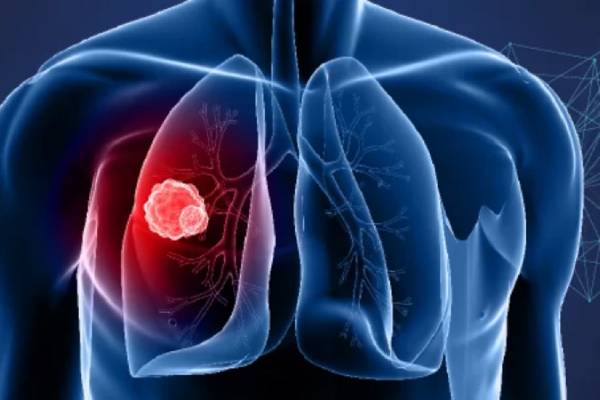 Lung Cancer Surgeon in Hyderabad