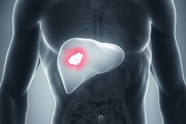 Liver Cancer Surgeon in Hyderabad