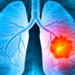 Know the Reason of Lung Cancer Among People Who Never Smoked