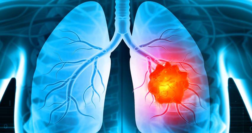 Know the Reason of Lung Cancer Among People Who Never Smoked