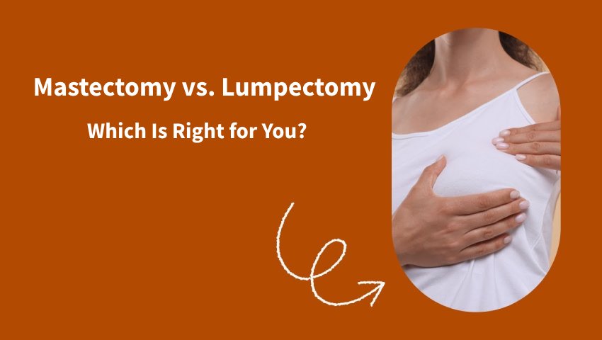 Mastectomy vs. Lumpectomy: Which Is Right for You?