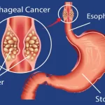 Esophageal cancer diagram showing tumour near the stomach — highlights Robotic and Laparoscopic Surgery.