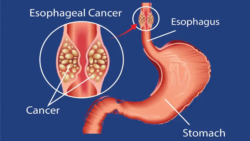 Esophageal cancer diagram showing tumour near the stomach — highlights Robotic and Laparoscopic Surgery.