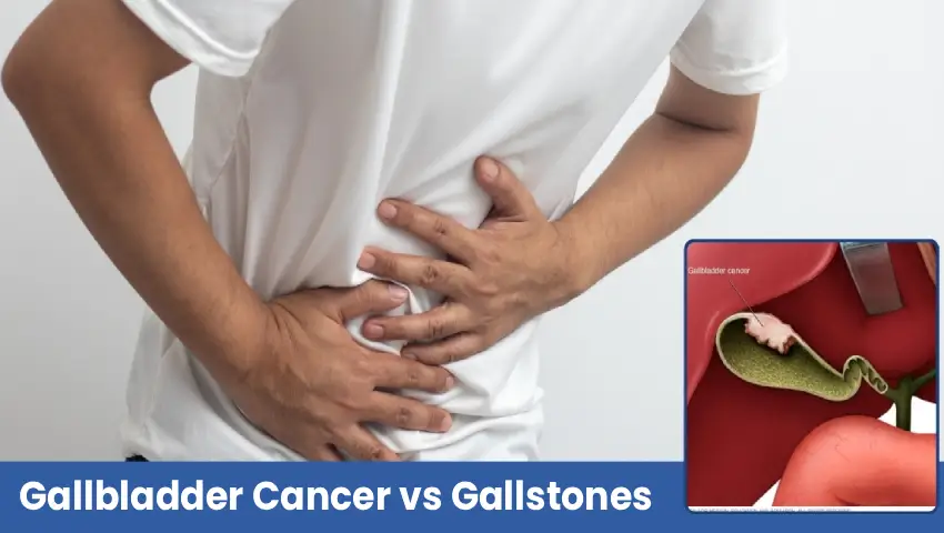 Gallbladder Cancer vs Gallstones: How to Know the Difference
