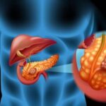 Illustration showing the pancreas with a highlighted tumour to explain the connection between diabetes and pancreatic cancer risk