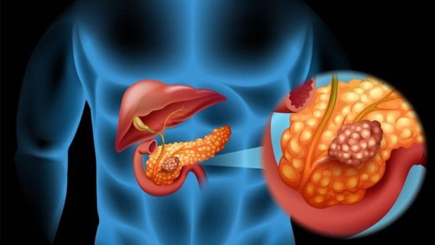 What Is the Link Between Diabetes and Pancreatic Cancer Risk?