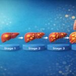 An educational medical diagram illustrating the Stages of Liver Cancer, from early localized nodules to stage 4 liver cancer. The visual highlights a visible lump on liver tissue and shows the progression of cancer spread liver to nearby blood vessels and distant organs, providing a clear comparison of liver tumor images for patient awareness.